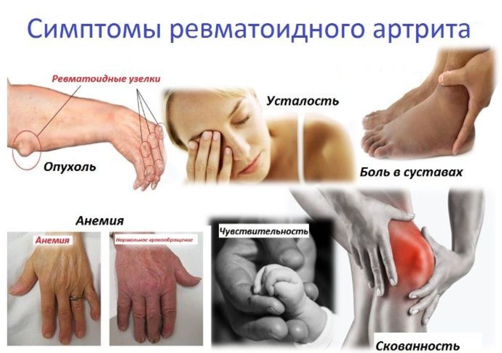 Ревматоидный артрит симптомы