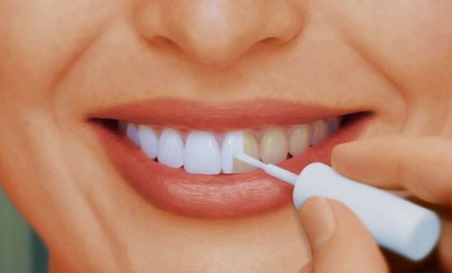 Отбеливание зубов домашние способы