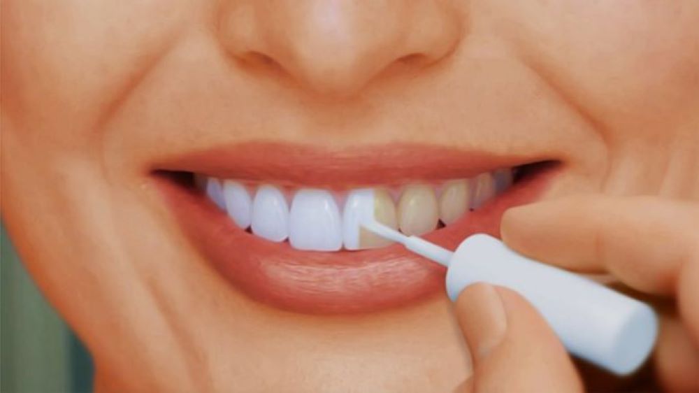 Photo of Отбеливание зубов: домашние способы