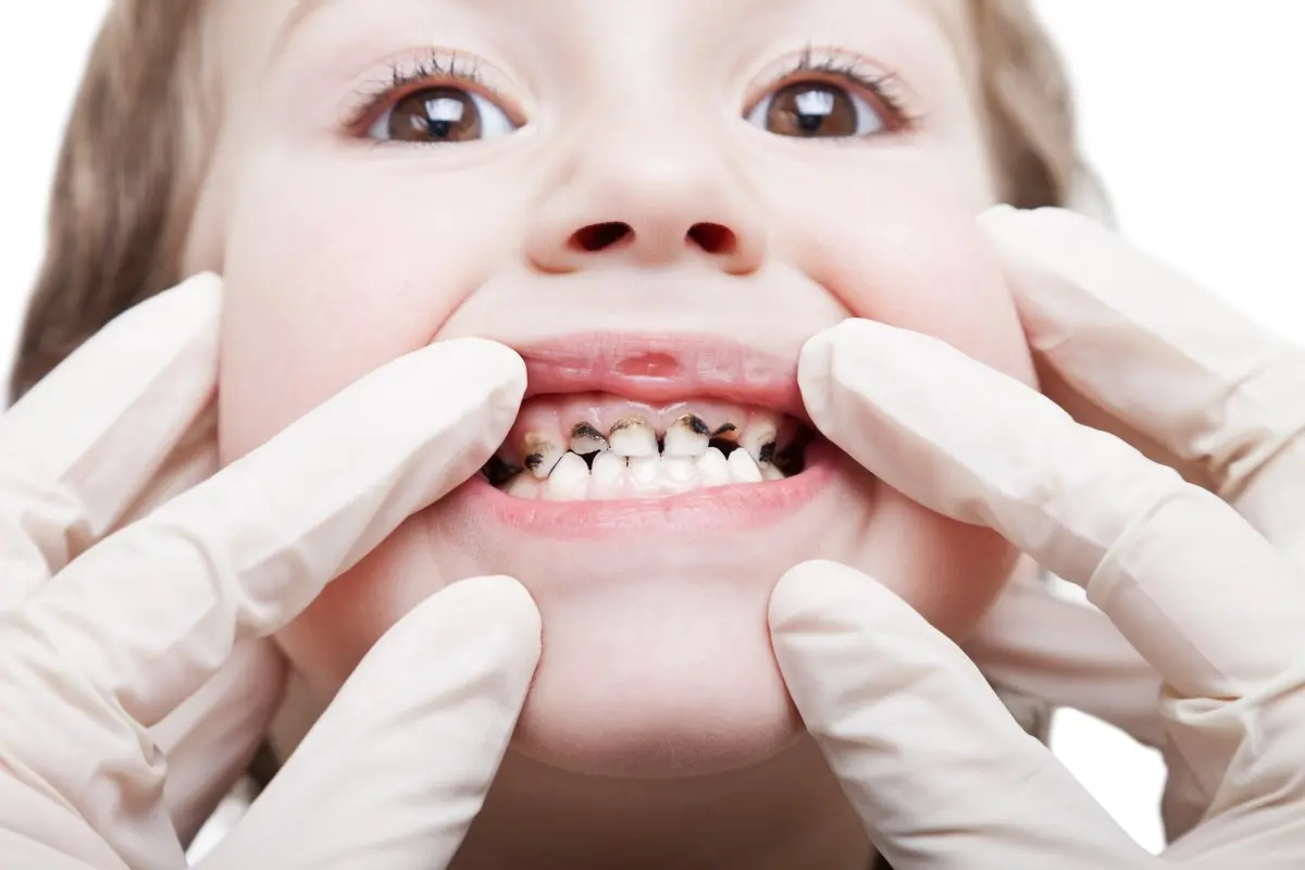 Какие заболевания могут возникнуть, если не лечить детские зубы?